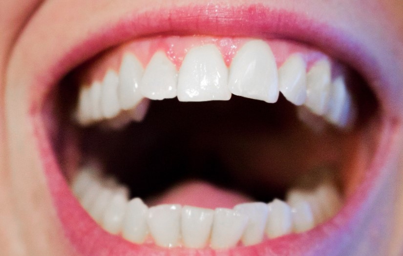 Severe Gum Disease